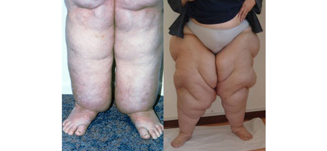 Lipedema Treatment San Diego  Lipedema Lymphatic Drainage San Diego