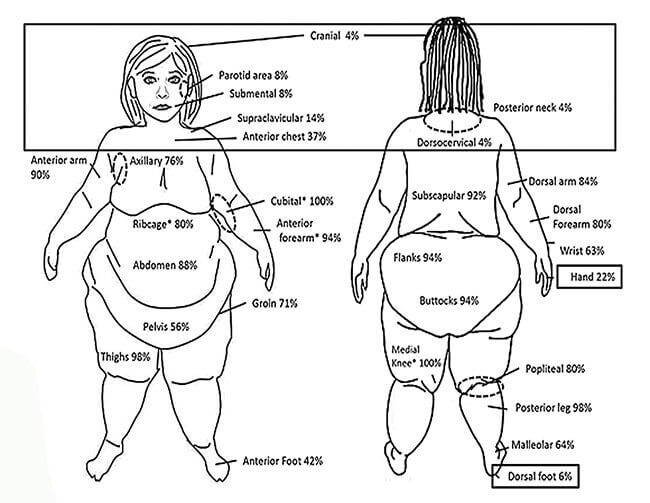 The Dos and Don'ts of Lipedema by Lymphatic Therapy Services - Issuu