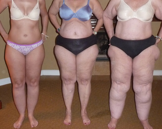 Three stages of Lipedema
