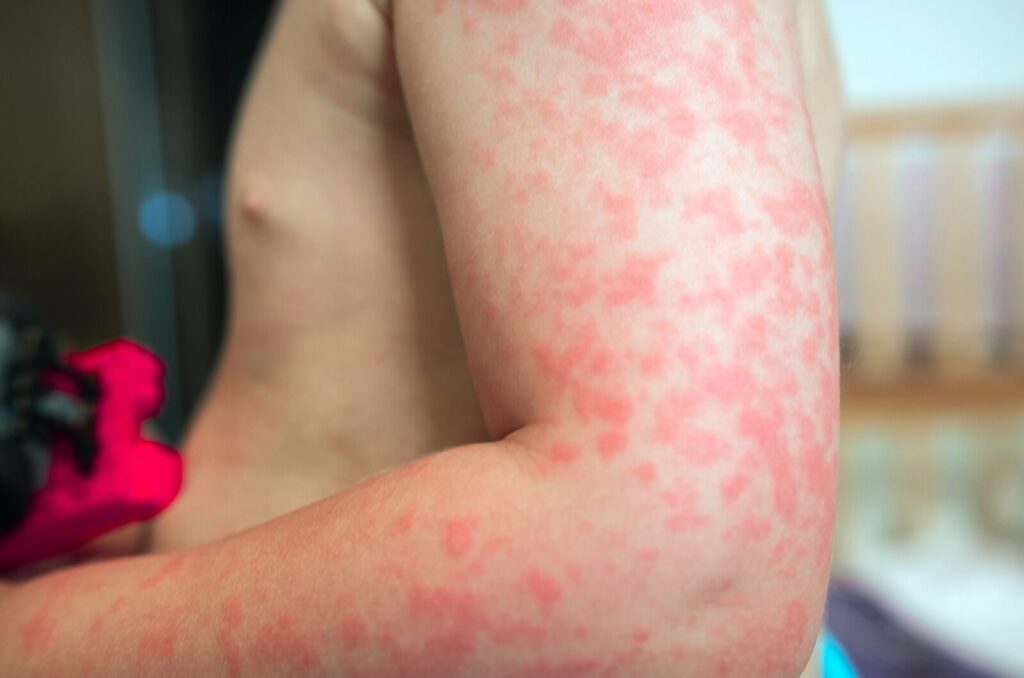 Red skin rash on arm showing early Lyme disease symptom after tick bite