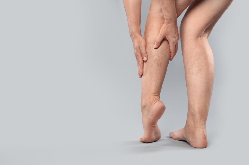 Person holding lower leg with visible vein changes, highlighting leg pain and circulation issues from CVI
