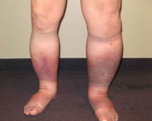 Chronic Venous Insufficiency