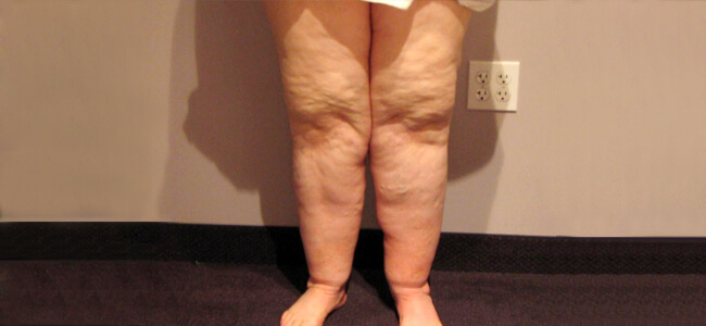 Lipedema Treatment San Diego  Lipedema Lymphatic Drainage San Diego