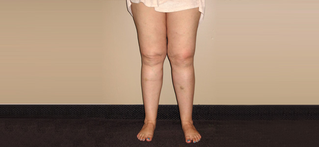 Where Does Lipedema Fat Accumulate?