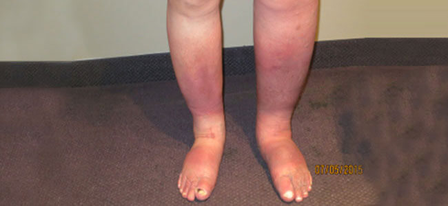 After Therapy of Venous insufficiency - Lymphatic Therapy