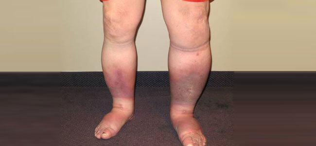 Before Therapy of Venous insufficiency - Lymphatic Therapy