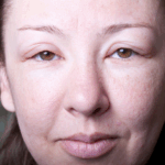 lymphedema treatment san diego