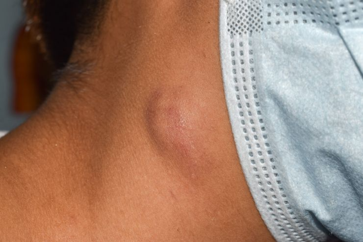 Long-term Lymph Node Swelling Can Mean