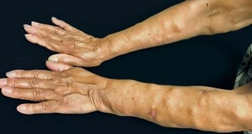 Two human arms with swelling and uneven skin texture, showing painful fatty lumps commonly seen in Dercum’s disease.