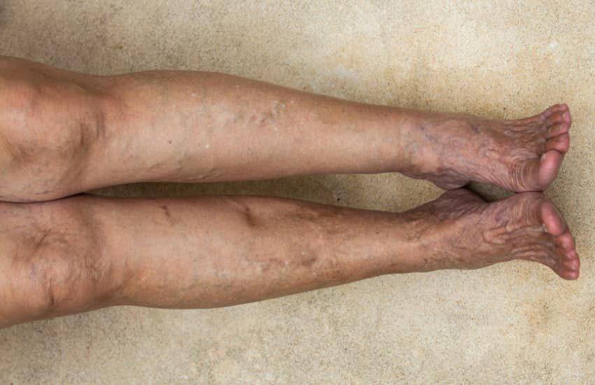 Legs showing visible varicose veins and skin changes, early signs of chronic venous insufficiency.