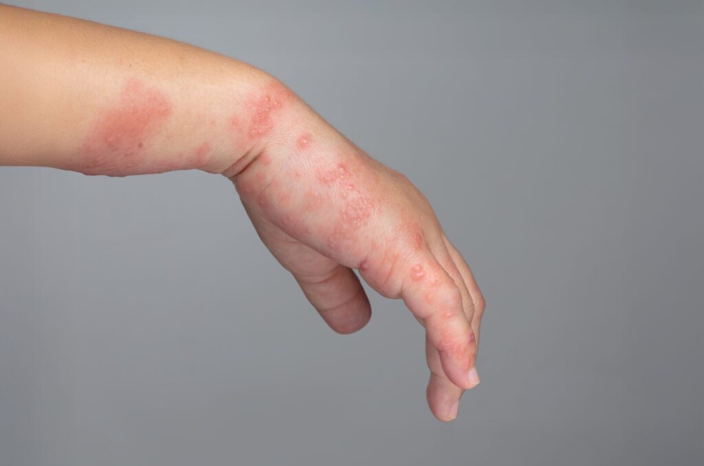 Hand with red patches and raised bumps, possibly linked to Dercum’s disease, causing painful fatty growths.