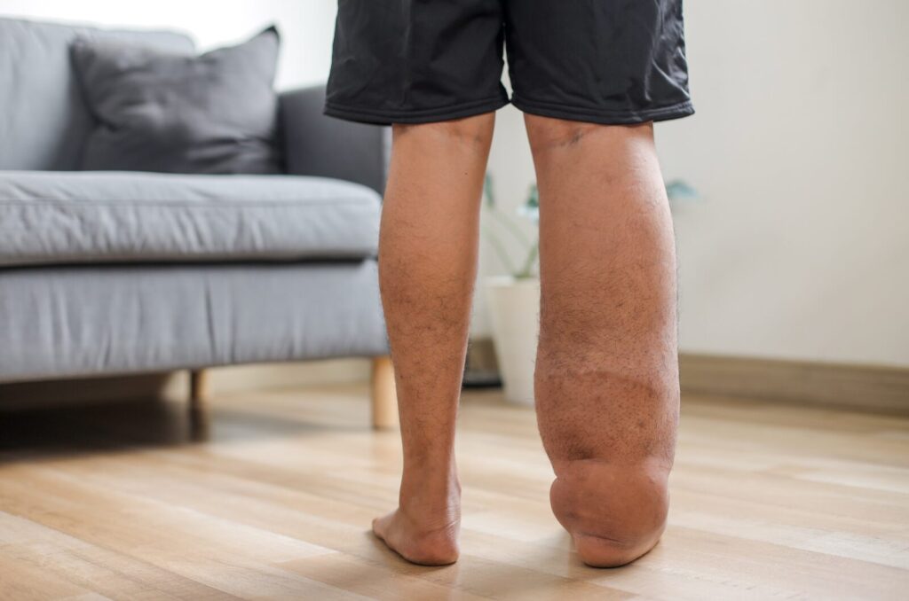 Lower leg swelling caused by lymphedema showing fluid retention, asymmetry, and unexplained rapid weight gain