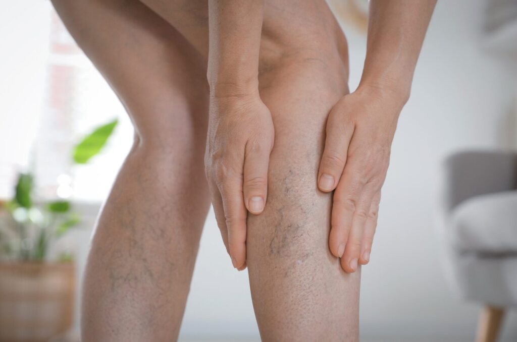 Legs affected by chronic venous insufficiency with visible veins, swelling, and pain-related discomfort